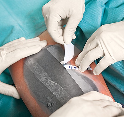 A surgical team is operating on a chronic wound